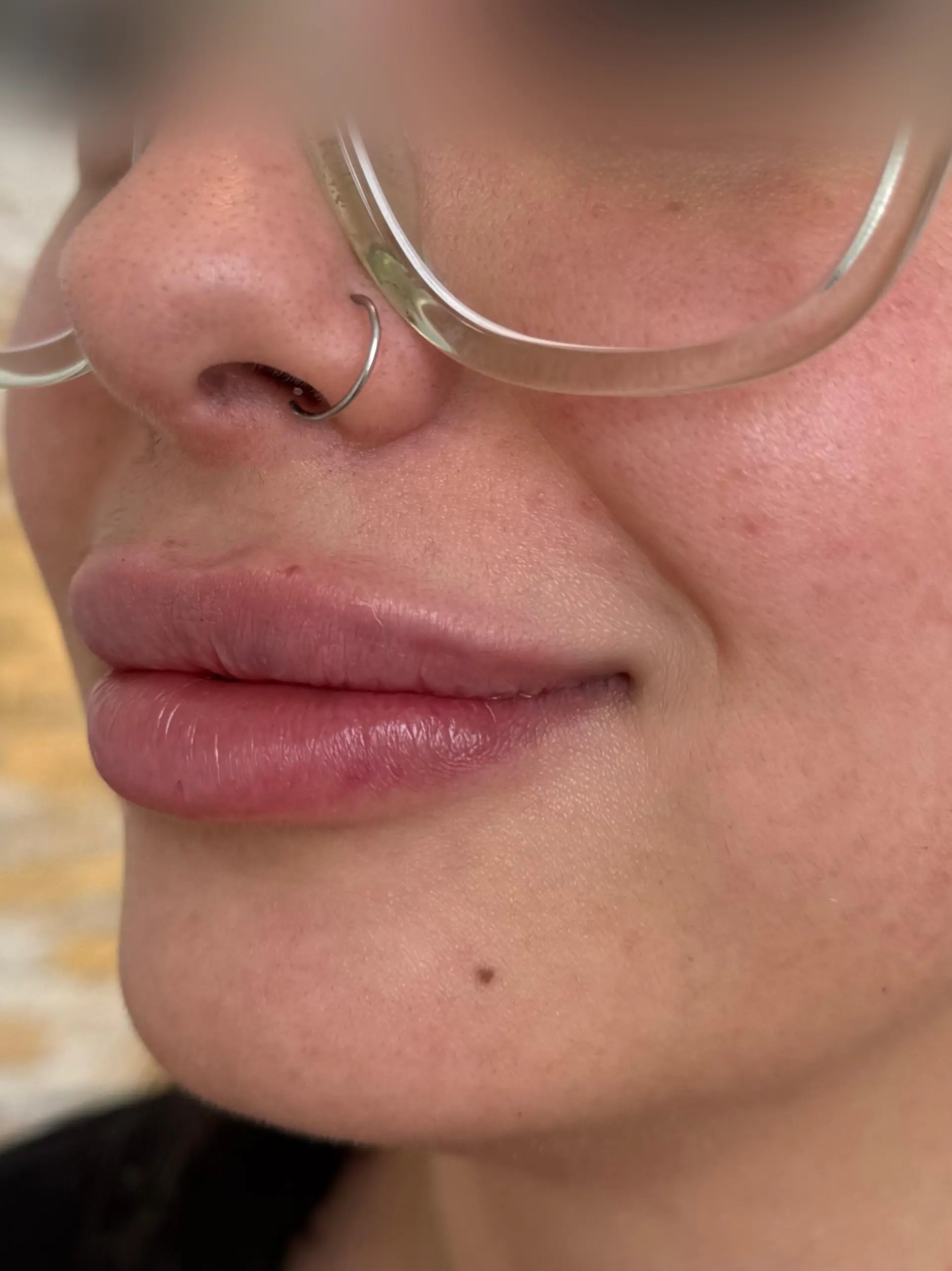 Lip Enhancement After