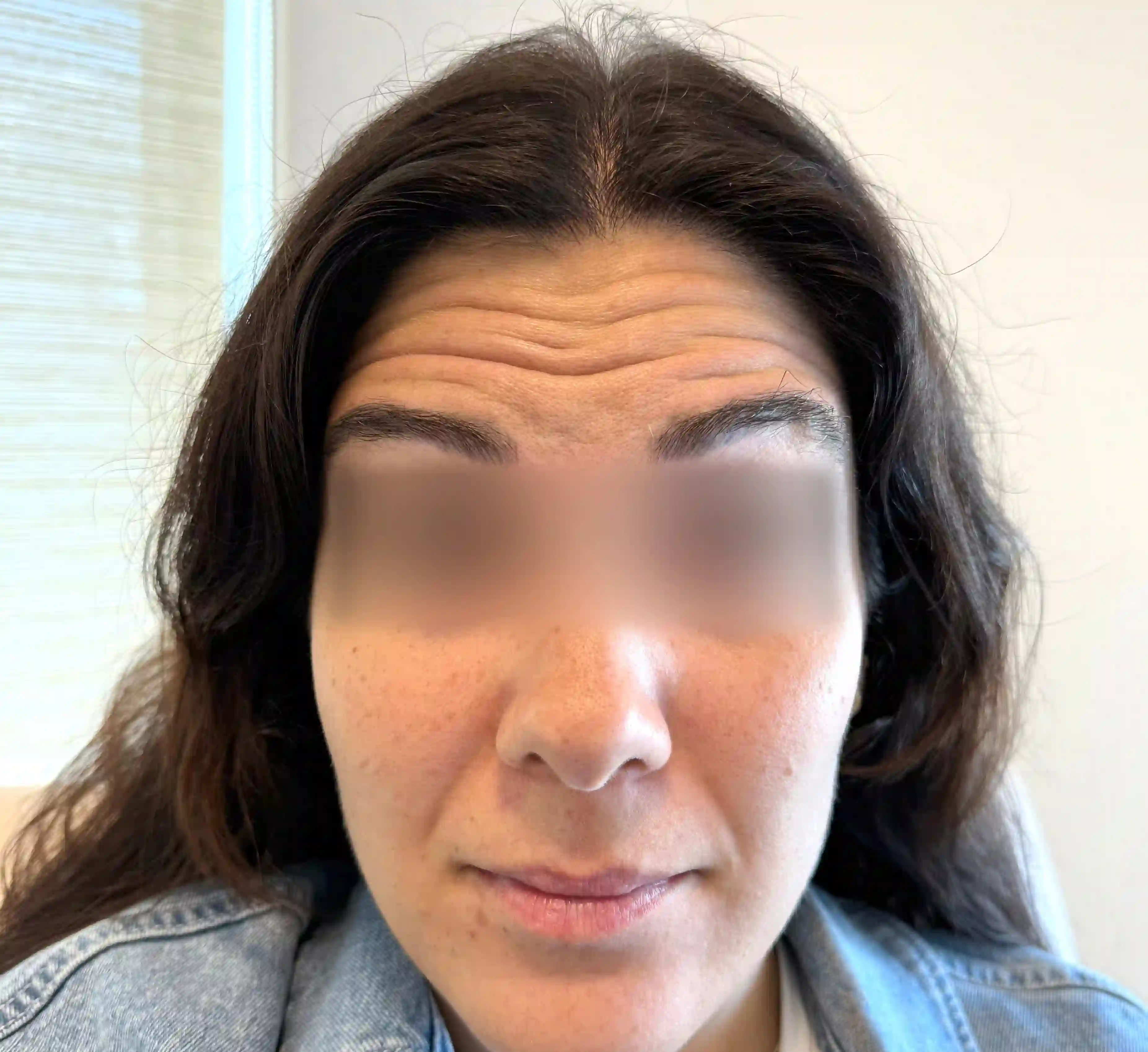 Forehead Before