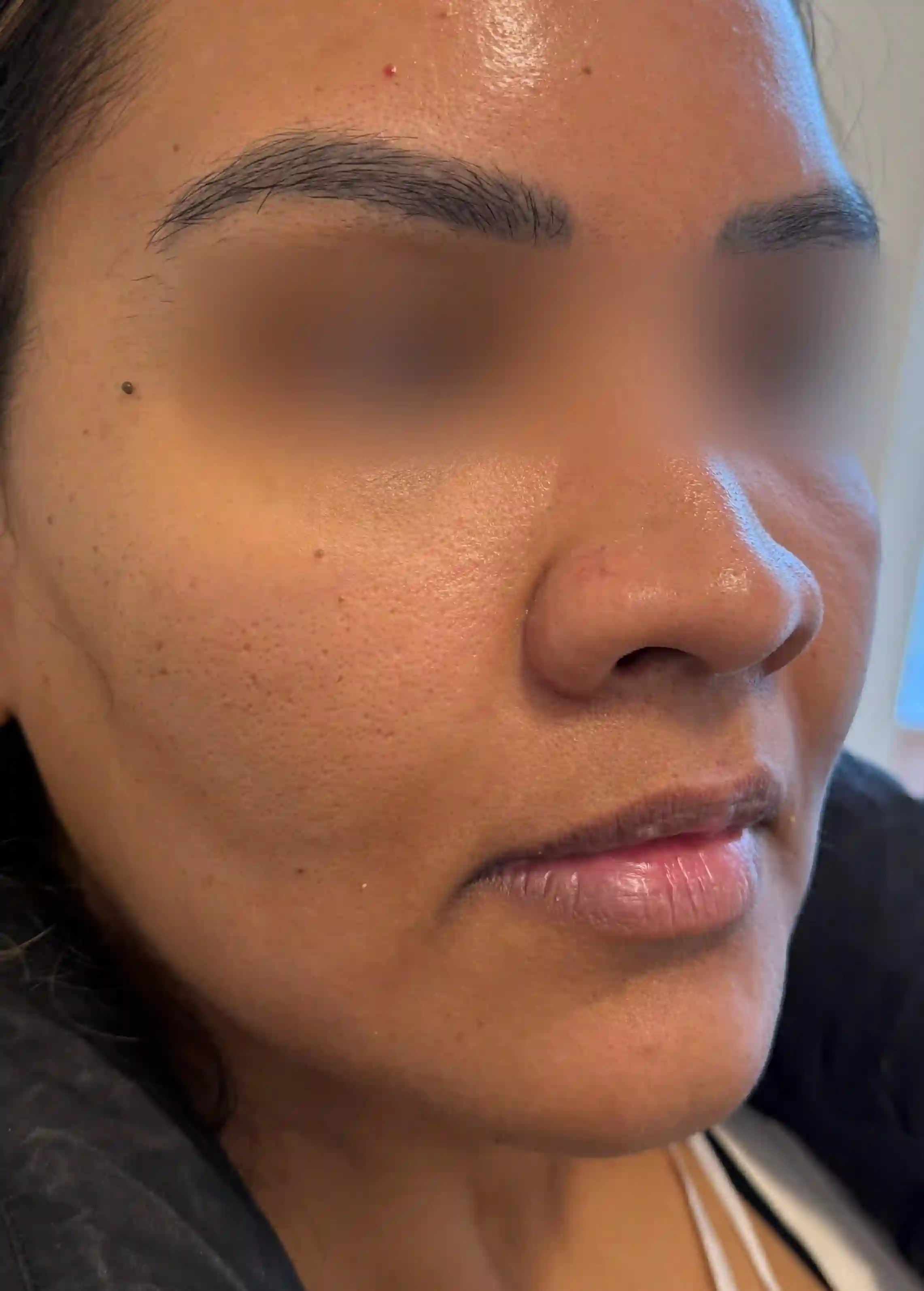 Cheek Filler After