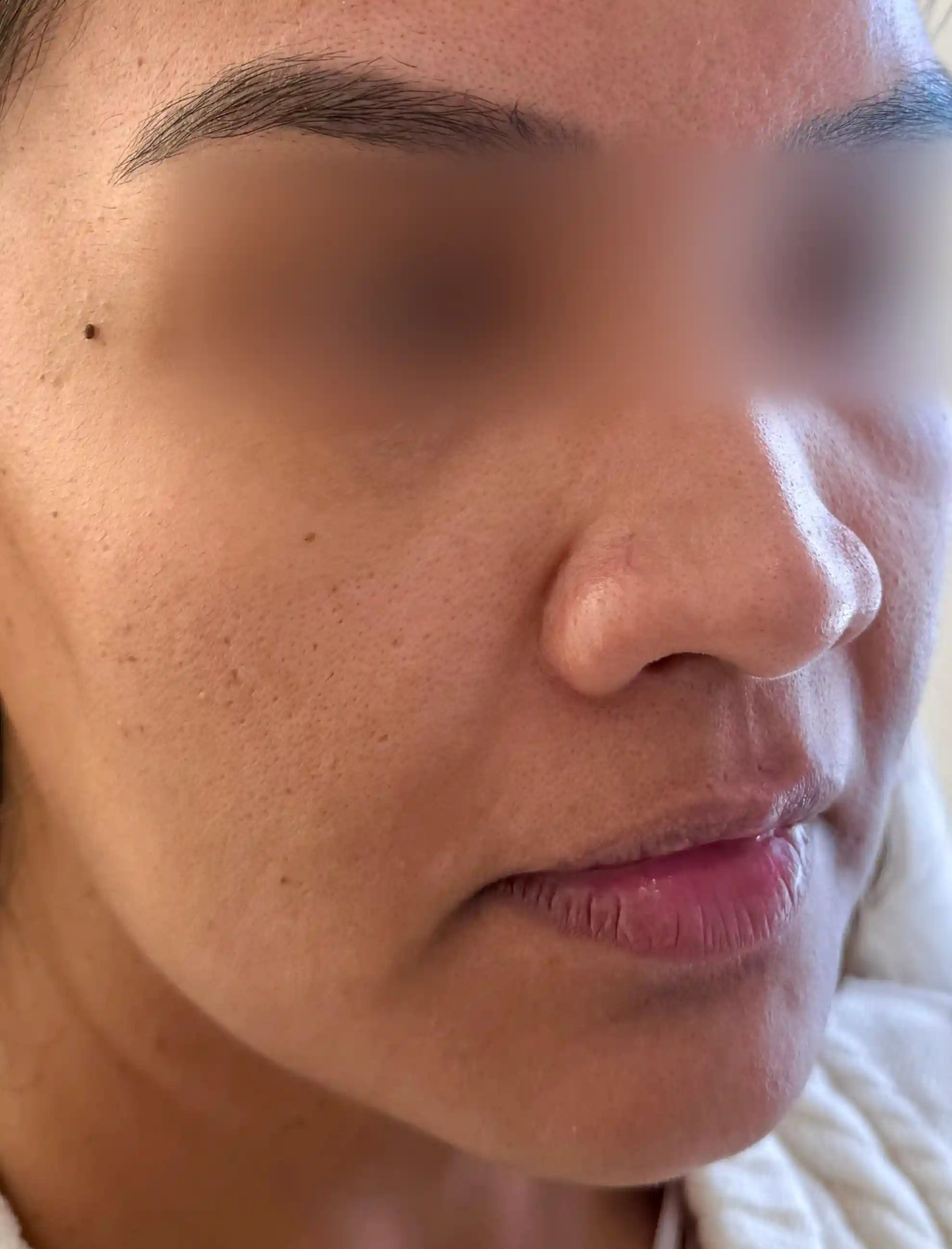 Cheek Filler Before