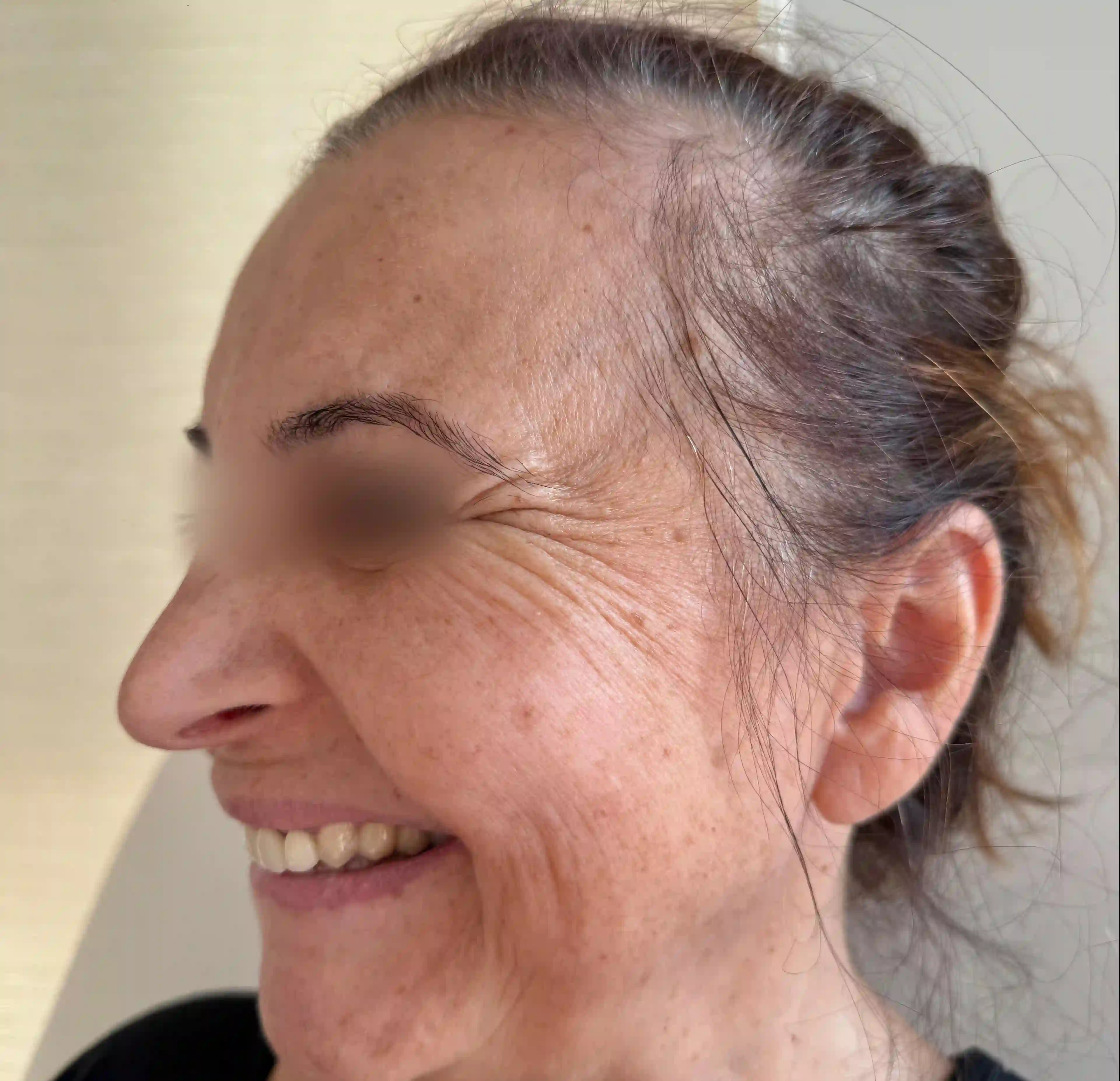 Crows Feet Before